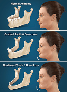 Full Arch Dental Implants The Villages® Community
