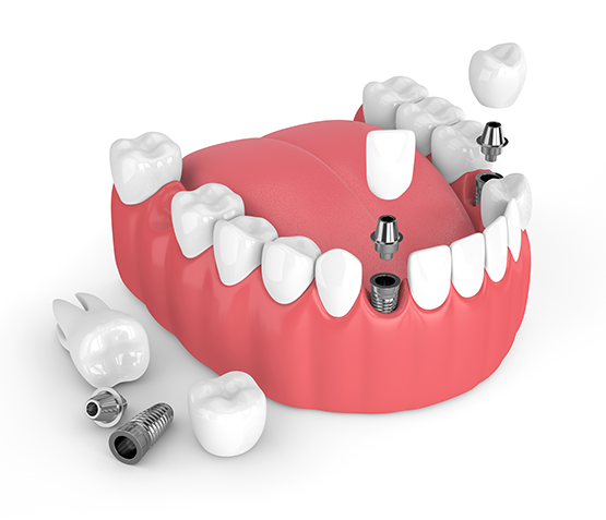 Dental Implants The Villages® Community FL