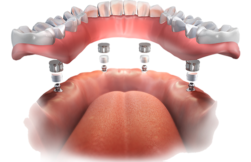 Implant Overdentures The Villages® Community